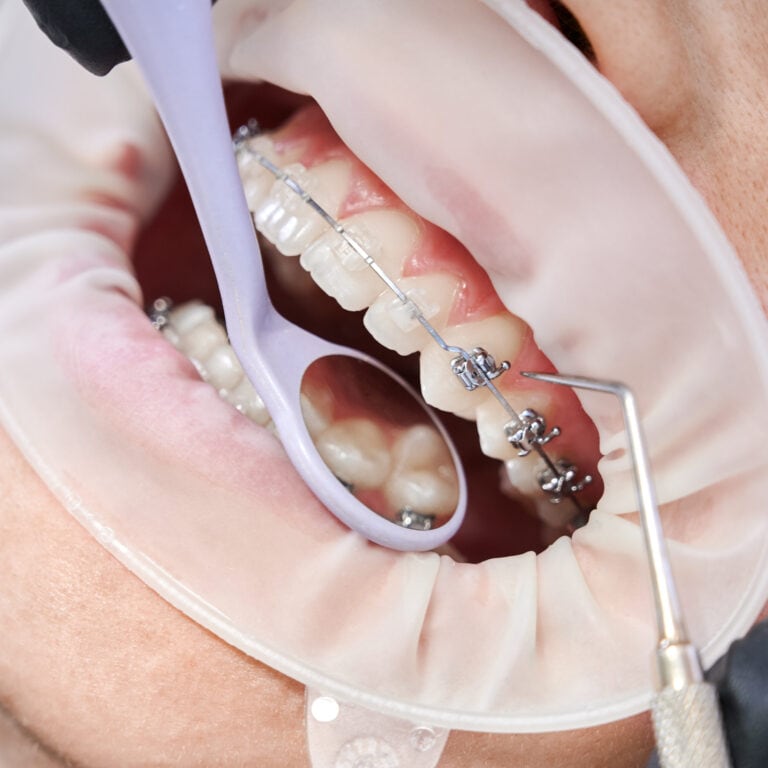 Brace Yourselves: Types of Orthodontic Braces